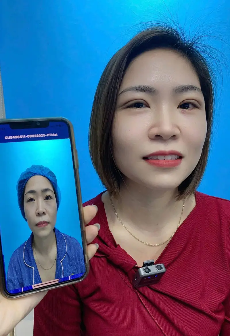 Mí mắt khách hàng sau khi vết thương cắt mí đã lành