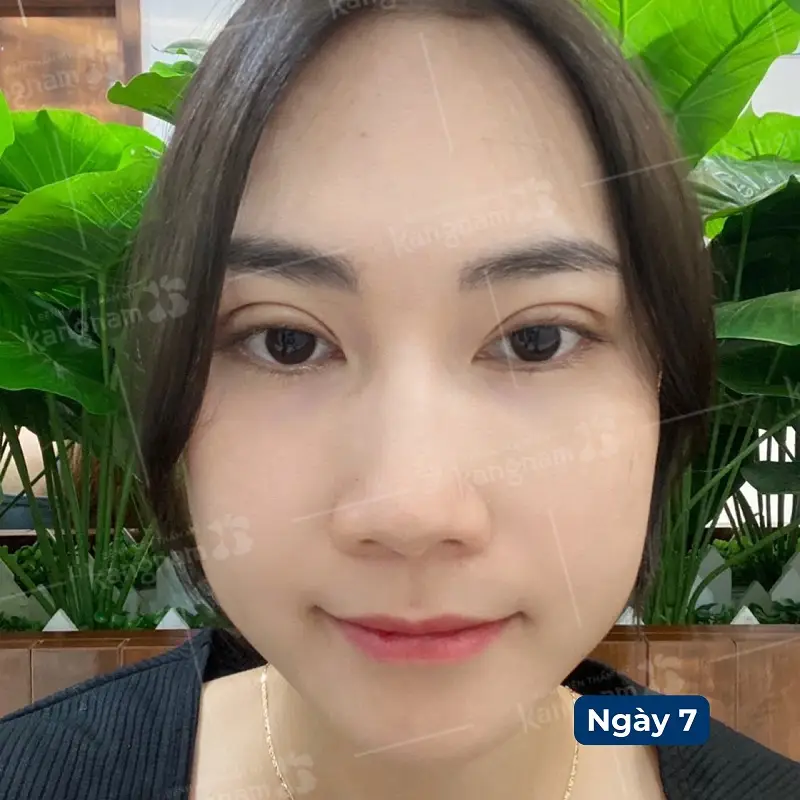 Mí mắt của khách hàng đã hết sưng sau khoảng 1 tuần