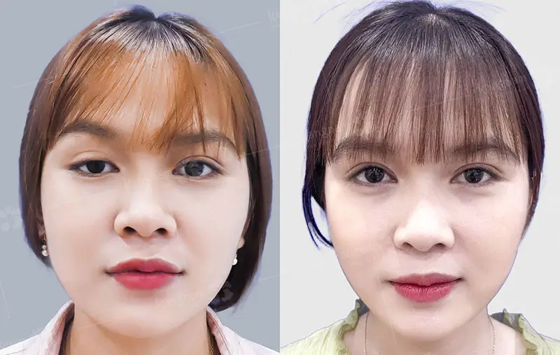 Với những bạn trẻ khi cắt mí đúng kỹ thuật không gây ra tình trạng sụp mí