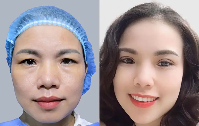 Ở độ tuổi trung niên cắt mí giúp đôi mắt tươi trẻ, khắc phục tình trạng sụp mí