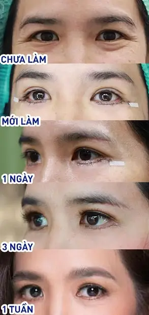 Hình ảnh cắt mí dưới sau 7 ngày 