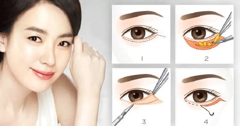 Cắt mí dưới giúp loại bỏ nếp nhăn hiệu quả