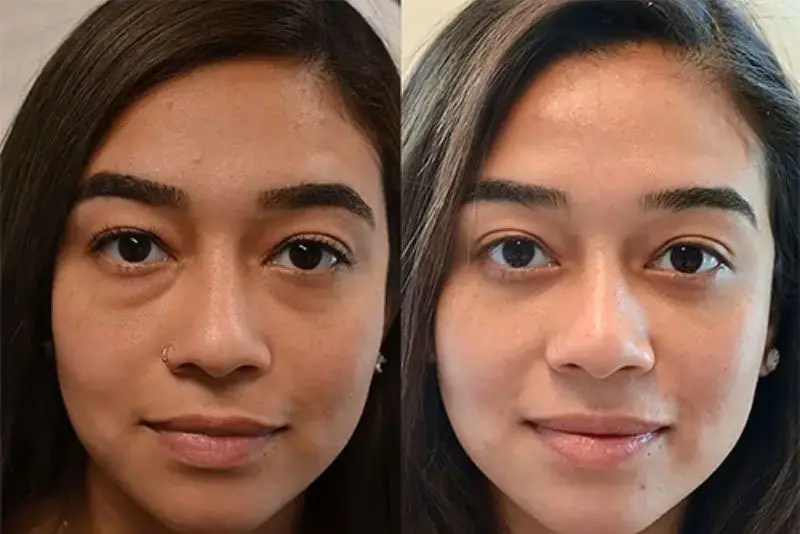 Đôi mắt tươi trẻ, hài hòa hơn