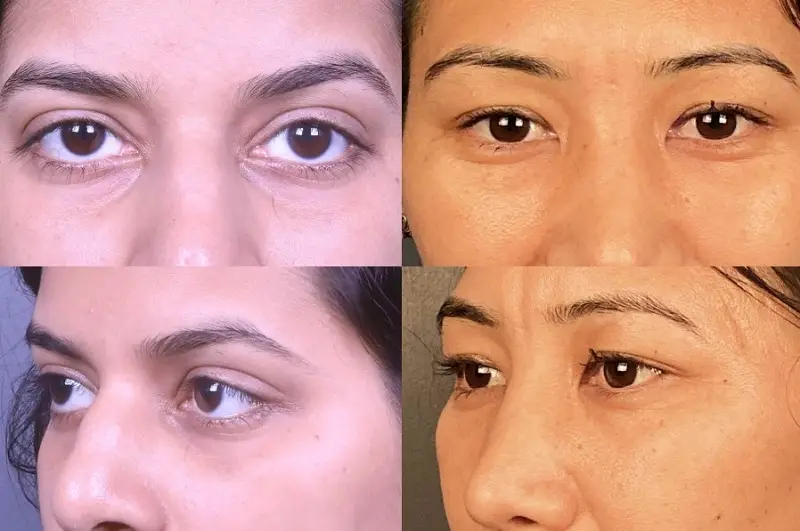 Cắt mí mắt Ấn Độ phù hợp với những trường hợp gặp tình trạng mí lót, mí ẩn