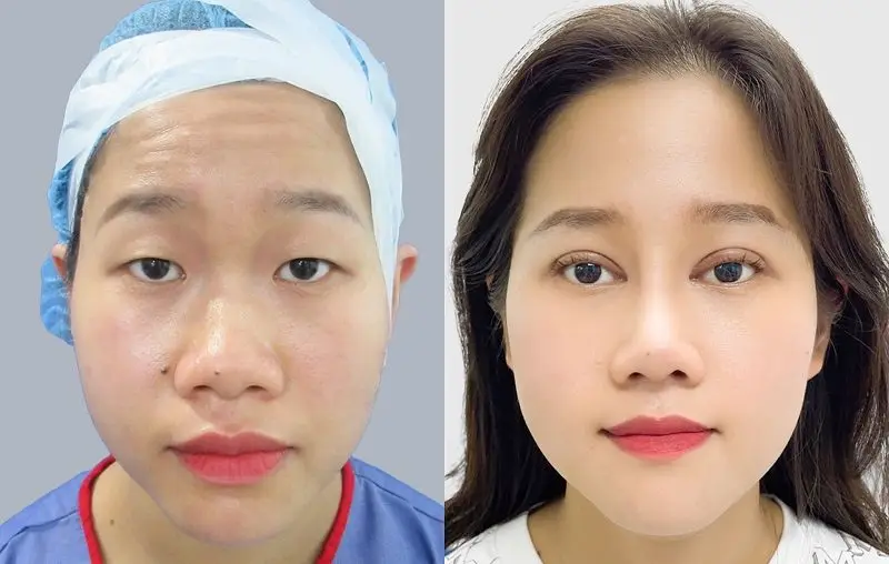 Sử dụng công nghệ cắt mí hiện đại giúp mí mắt nhanh vào nếp, đẹp tự nhiên