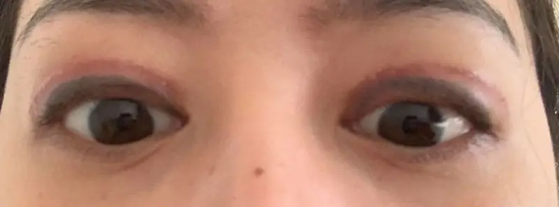 Loại bỏ nhiều da khiến mí mắt không thể nhắm kín