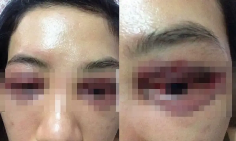 Mắt bị chảy máu, tụ máu sau cắt mí hỏng