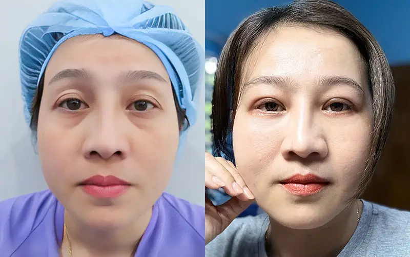 Cấy mỡ hốc mắt giúp khắc phục tình trạng mí mắt quá sâu
