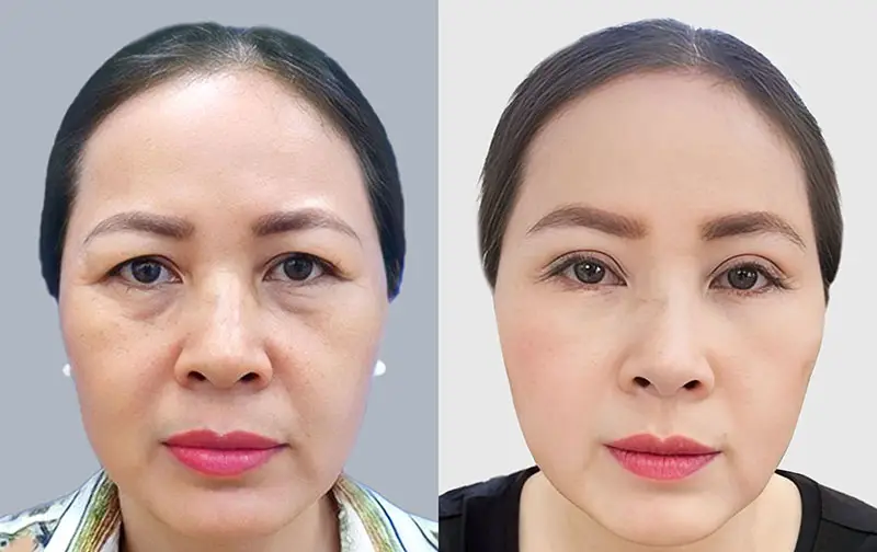 Cắt mí mắt dưới có tác dụng loại bỏ bọng mắt, da dư, mỡ thừa