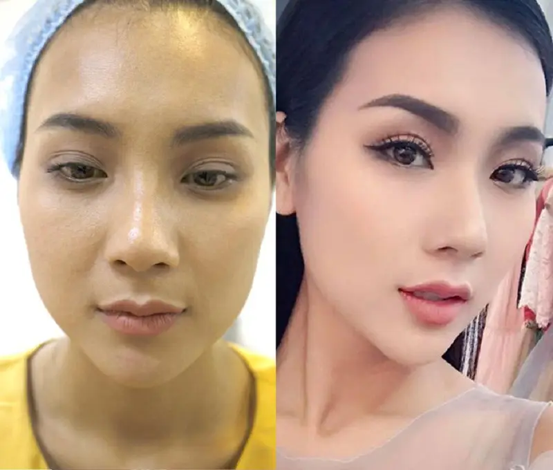 Cắt mí mini mang lại hiệu quả cao nhưng chỉ duy trì được từ 3 - 5 năm