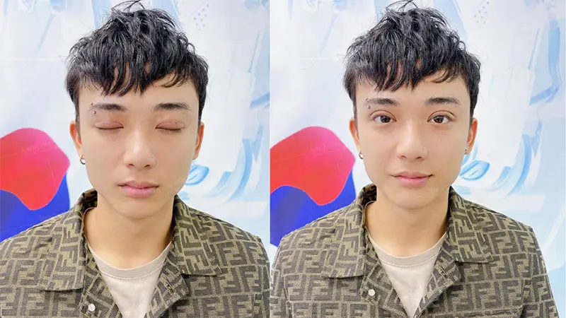 Cắt mí nam không khác nhiều so với cắt mí cho nữ giới