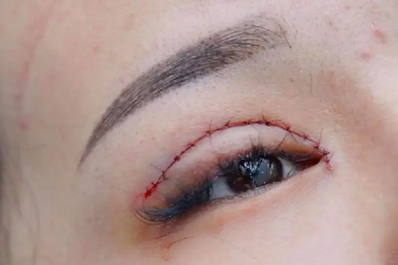 Chăm sóc mí sai cách khiến mắt sưng