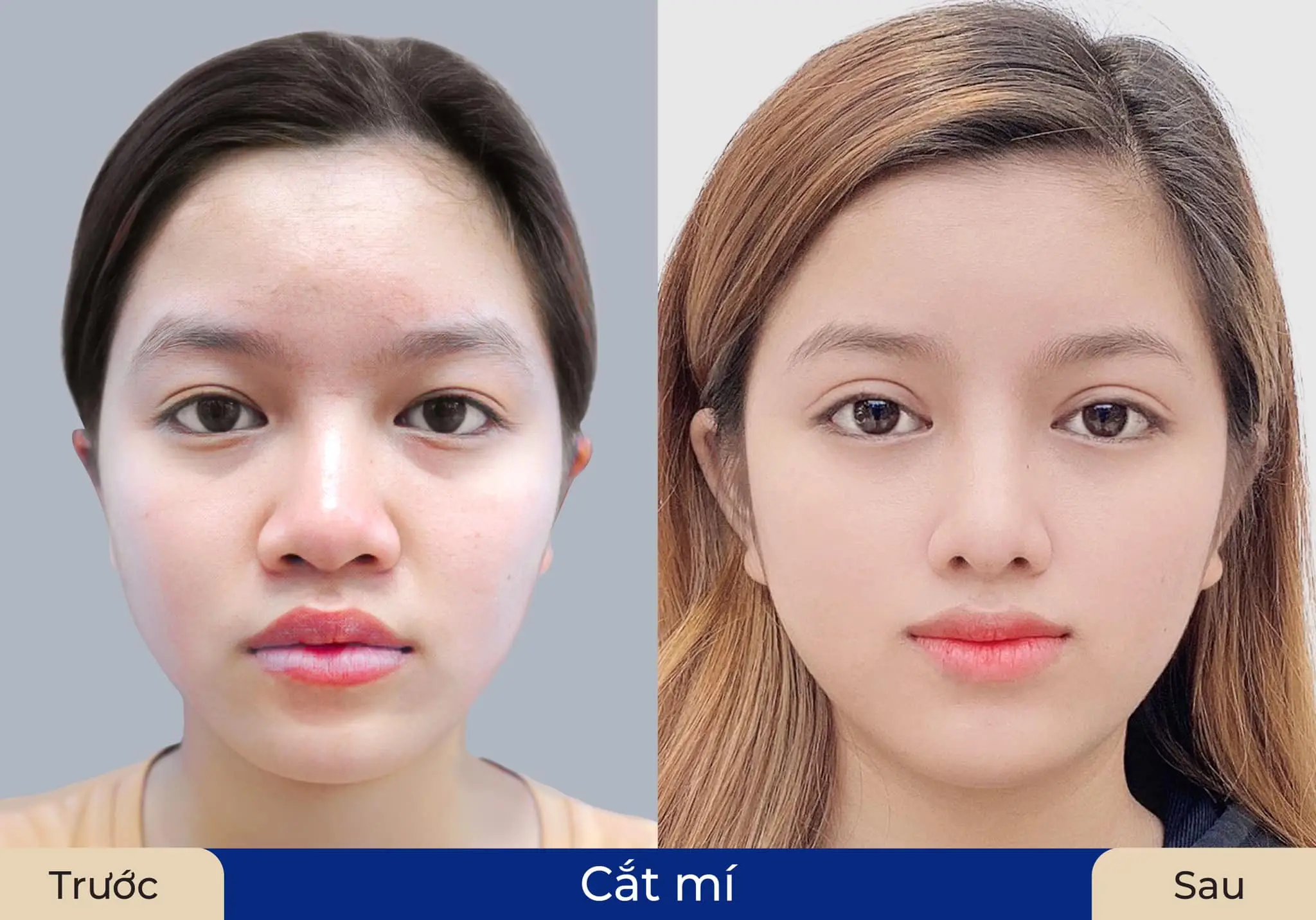 Hai đường mí cân đối, giúp gương mặt hài hòa