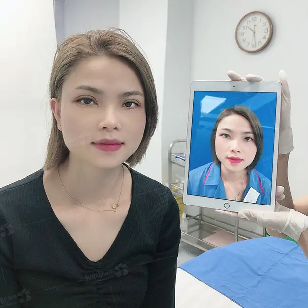 Mí mắt sau 5 ngày cắt mí vẫn hơi sưng nhẹ