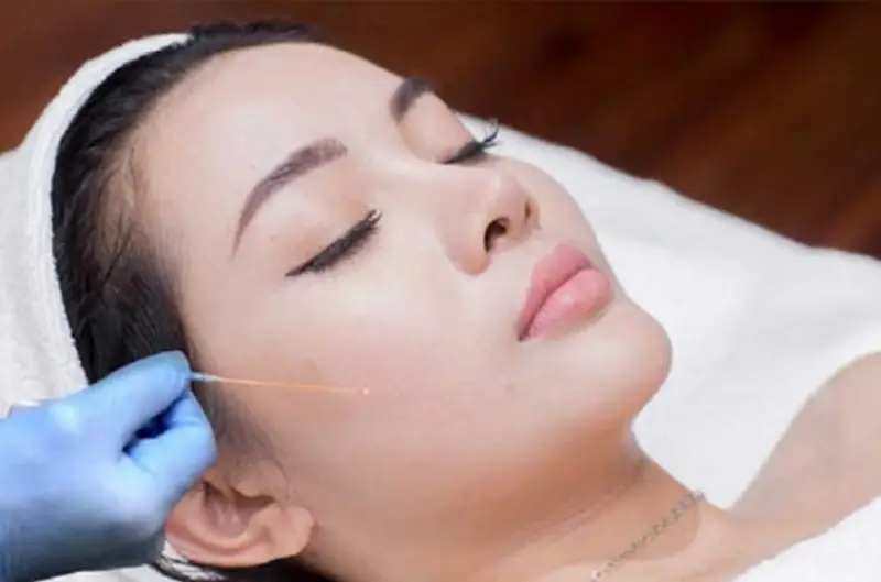 Sử dụng chỉ cấy chất lượng cao sẽ đảm bảo an toàn cho khách hàng