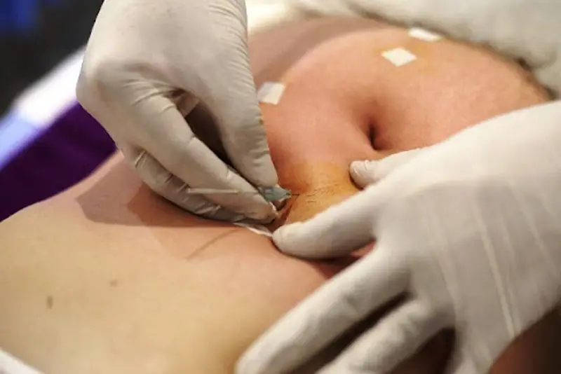 Cấy chỉ giảm mỡ bụng