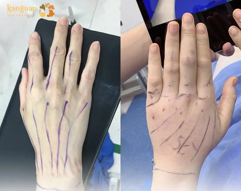 Tùy vào lượng mỡ cần cấy vào bàn tay của mỗi khách hàng
