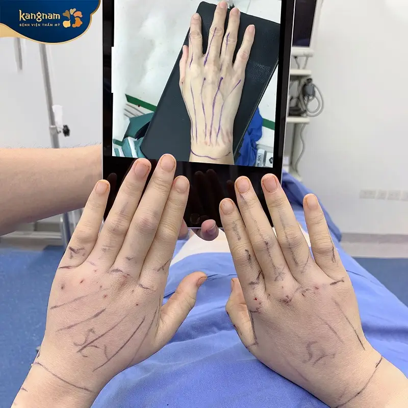 Phương pháp cấy mỡ bàn tay duy trì được hiệu quả lâu dài