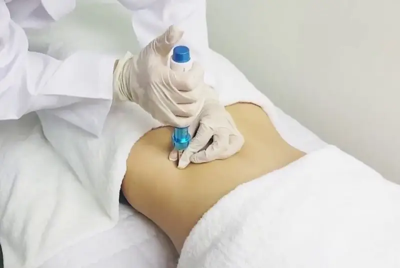 Cấy mỡ Enzyme đúng cách sẽ không gây biến chứng ảnh hưởng đến sức khỏe