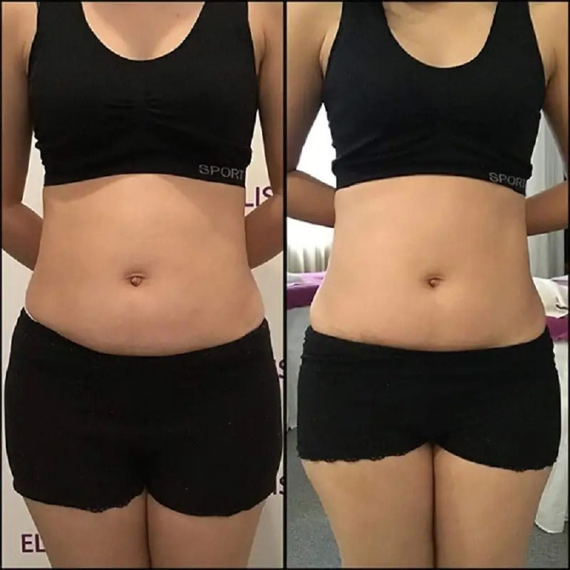 Nên lựa chọn đúng kỹ thuật giảm mỡ bụng để đảm bảo an toàn