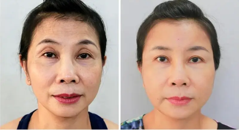 Thực hiện cấy mỡ mắt bằng công nghệ hiện đại giúp khách hàng đạt được kết quả tối ưu