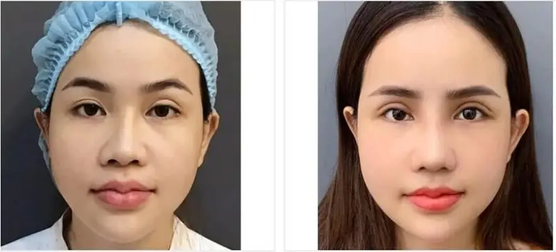 Sở hữu đôi mắt tươi trẻ, rạng ngời sau cấy mỡ hốc mắt