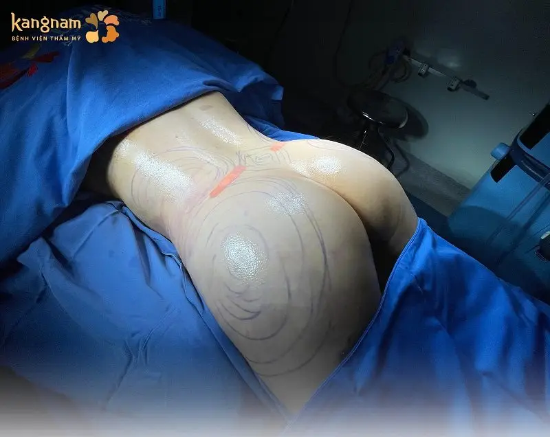 Những công nghệ cấy mỡ hiện đại sẽ có mức chi phí cao hơn