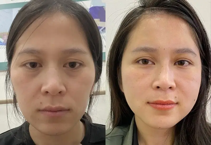 Cấy mỡ má bằng mỡ tự thân giúp tạo đường nét khuôn mặt tự nhiên, tươi trẻ