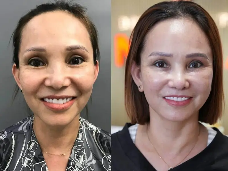 Chăm sóc da mặt đúng cách sẽ giúp triệu chứng sưng tấy sau cấy mỡ nhanh hết