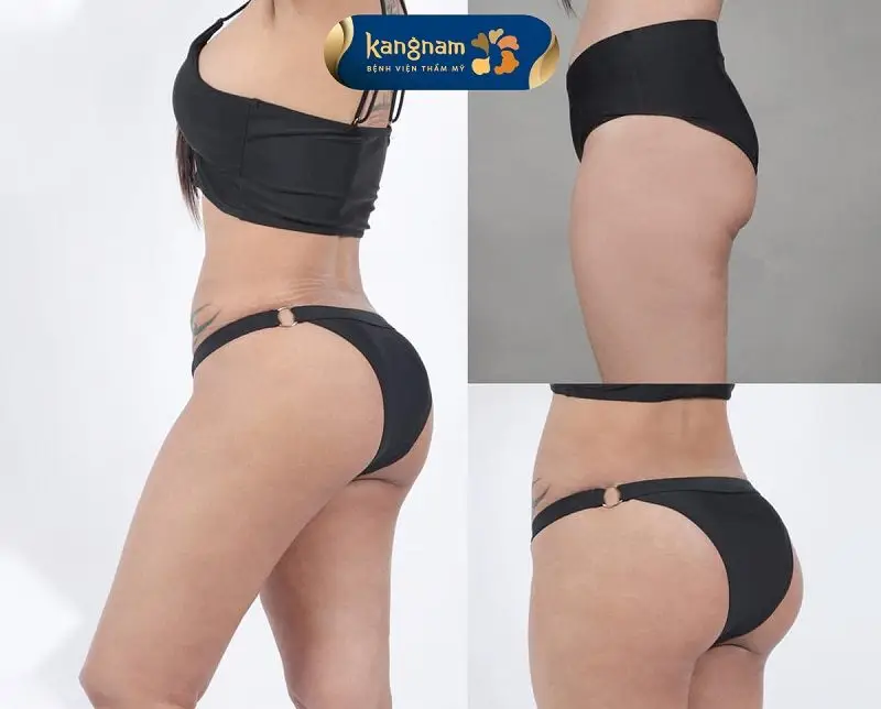 Vòng 3 căng tròn, sexy sau khi cấy mỡ mông