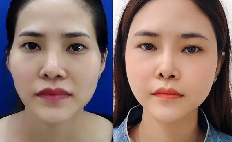 Cấy mỡ thái dương có hiệu quả duy trì được từ 2 - 3 năm