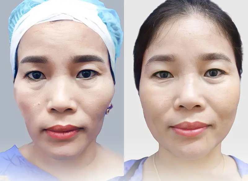 Cấy mỡ thái dương có thể bị tiêu do cơ thể hấp thụ một phần mỡ sau cấy