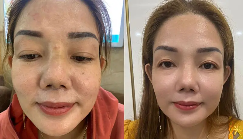 Phương pháp cấy mỡ trùng bì mũi được đánh giá là an toàn và hiệu quả cao