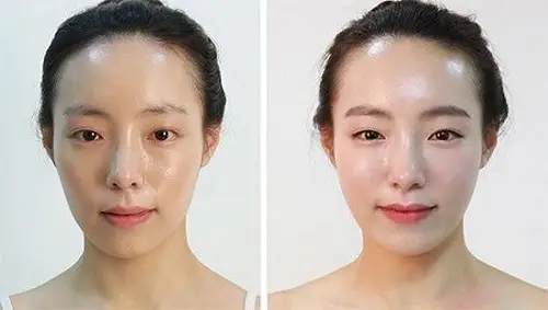 Cấy mỡ tự thân giúp khuôn mặt tươi trẻ hơn 