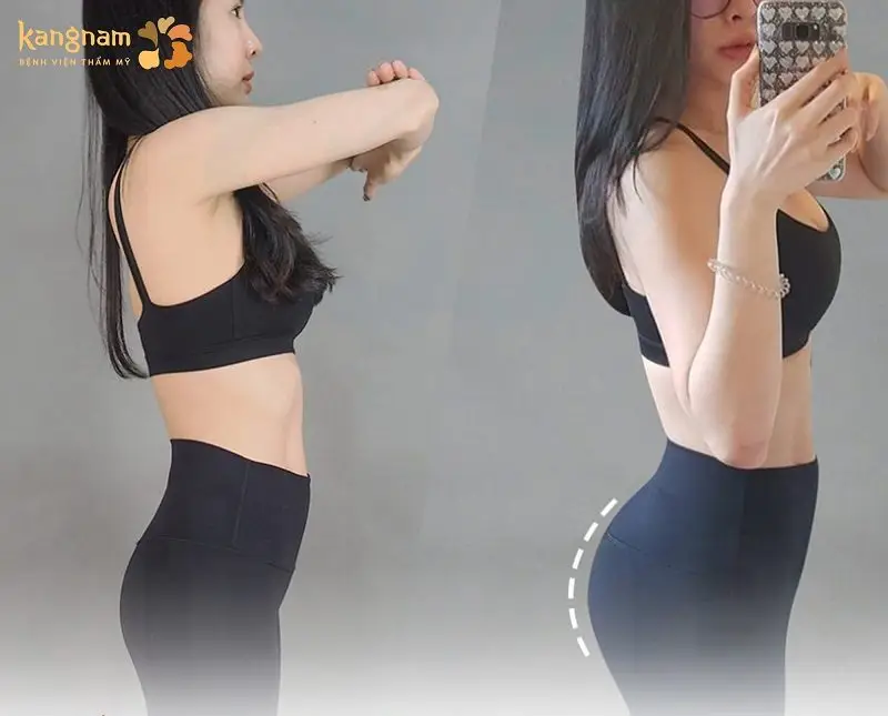 Những người có cơ địa bình thường thì hiệu quả cấy mỡ mông sẽ được lâu hơn