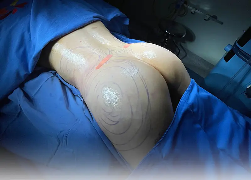 Cấy mỡ tự thân vào mông duy trì được bao lâu tùy thuộc vào kỹ thuật cấy mỡ