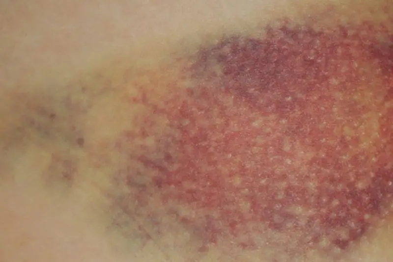 Máu tụ ở bầu ngực