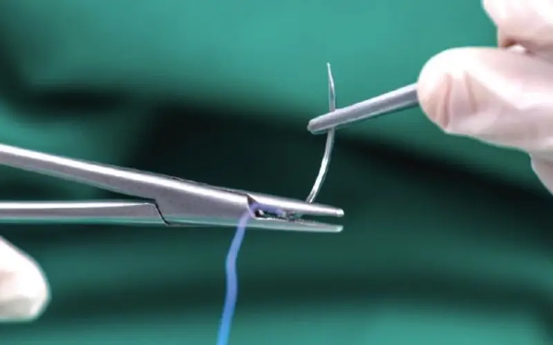 Chỉ tự tiêu có cơ chế tự phân hủy sau 1 thời gian