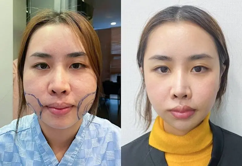 Hút mỡ mặt tại cơ sở uy tín giúp khách hàng sở hữu khuôn mặt thon gọn, cân đối