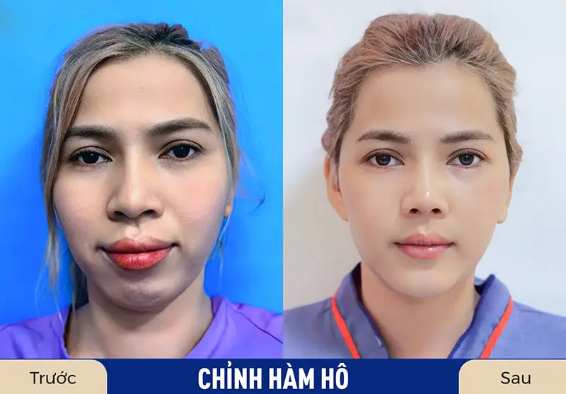 Khách hàng sau khi chỉnh hàm hô