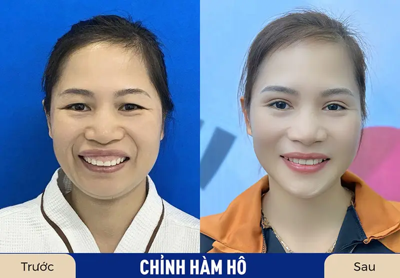 Chỉnh hàm hô chữa cười hở lợi