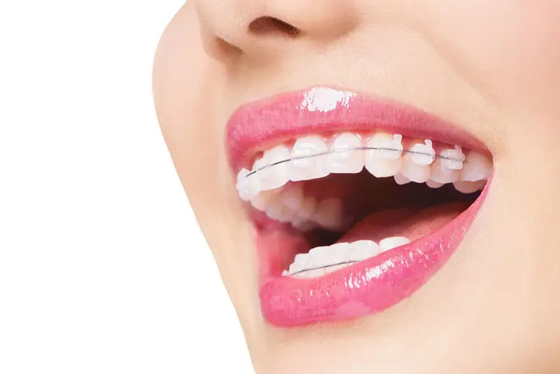 Niềng răng chữa cười hở lợi