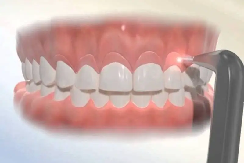 Cắt nướu chữa cười hở lợi