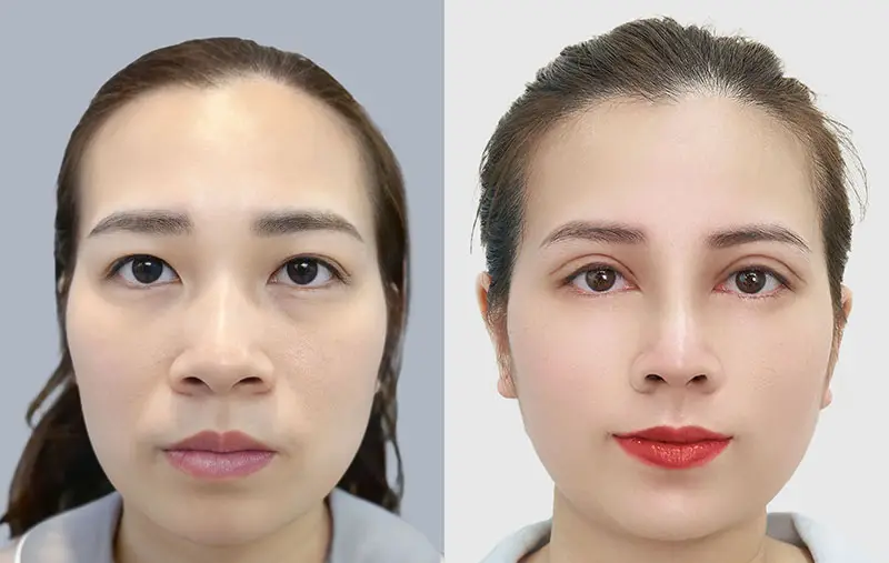 Cắt mí giúp đôi mắt to tròn và có hồn