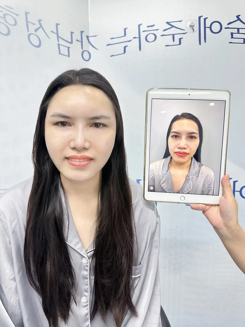 Khuôn mặt đầy đặn, cân đối sau khi cấy mỡ mặt