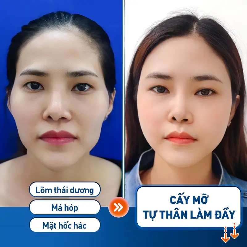 Cấy mỡ tự thân khắc phục được các khuyết điểm trên khuôn mặt