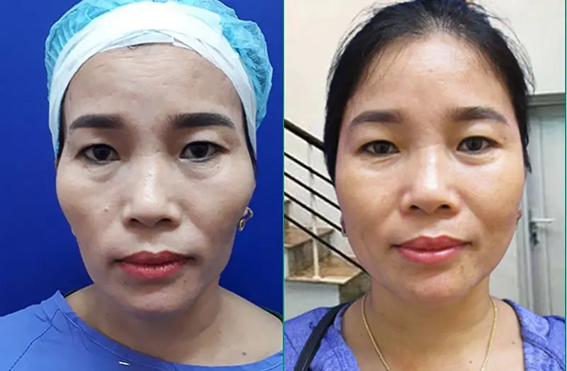 Khách hàng nên cấy mỡ mặt khi gặp tình trạng mặt lõm, hóp, thiếu sức sống