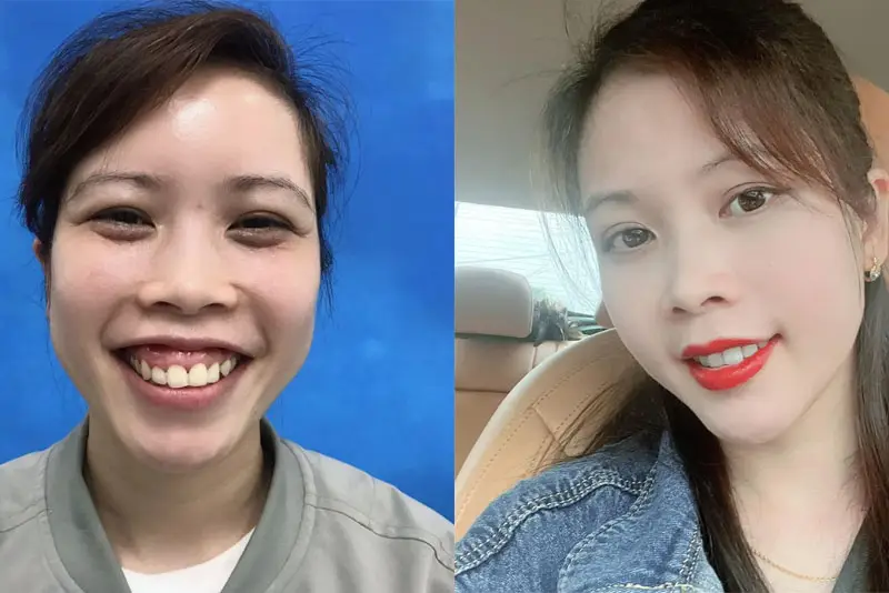 Kết quả sau phẫu thuật tự nhiên, giúp khách hàng sở hữu nụ cười đẹp