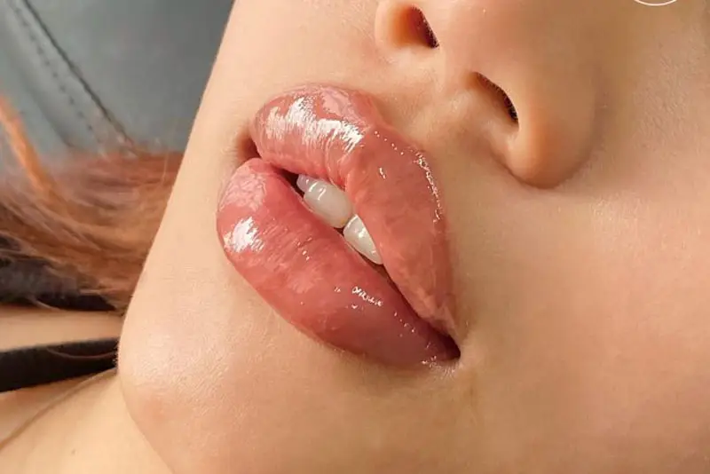 Tiêm filler dáng môi tều