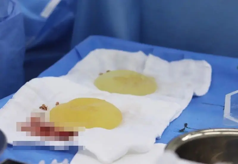 Bao xơ sau nâng ngực khiến bầu ngực sưng đau và cứng khi sờ vào